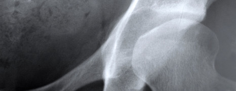 Osteoporóza